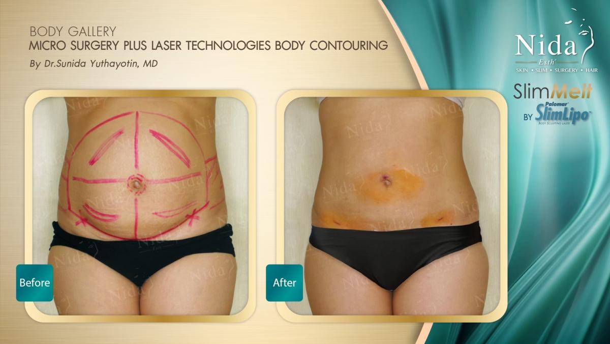 Slim melt Before After