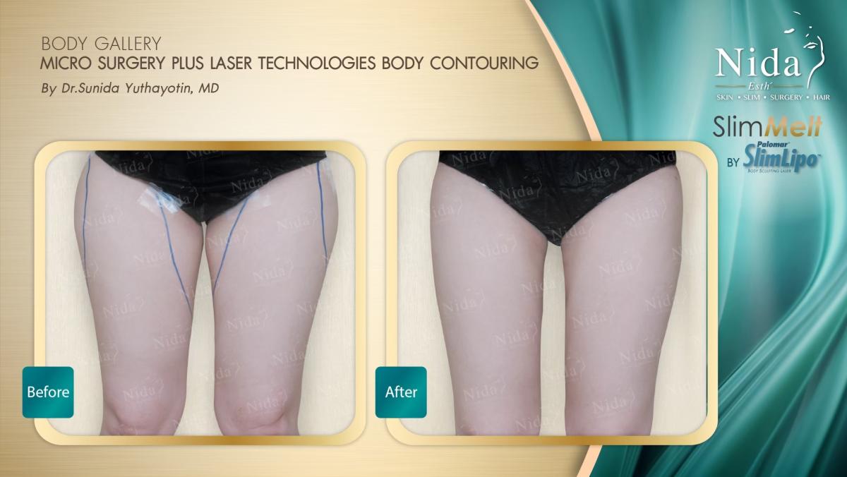 Slim melt Before After