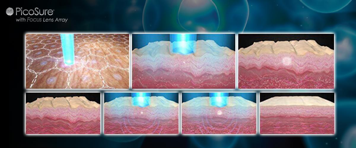 How does it work of PicoSure