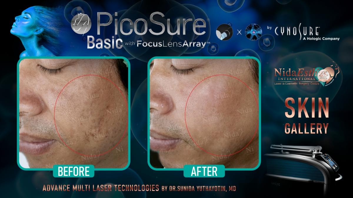 PicoSure Logo